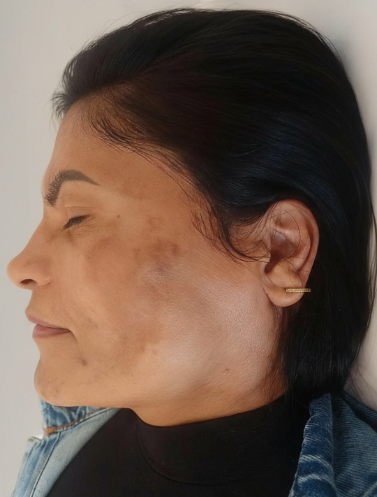 Antes - 30 dias de uso